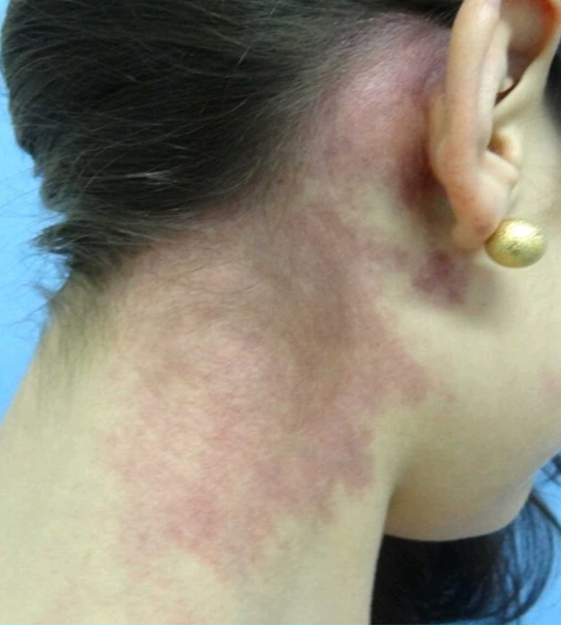 Pigment and Vascular Lesions The Laser Beautique