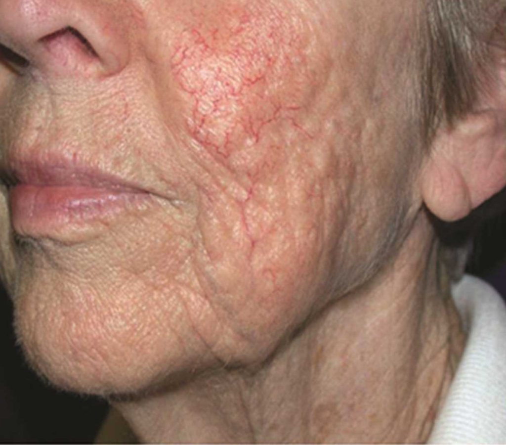 Pigment and Vascular Lesions The Laser Beautique
