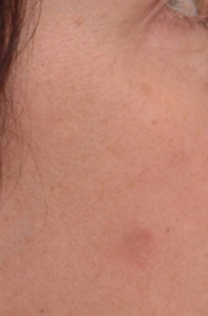 Pigment and Vascular Lesions The Laser Beautique