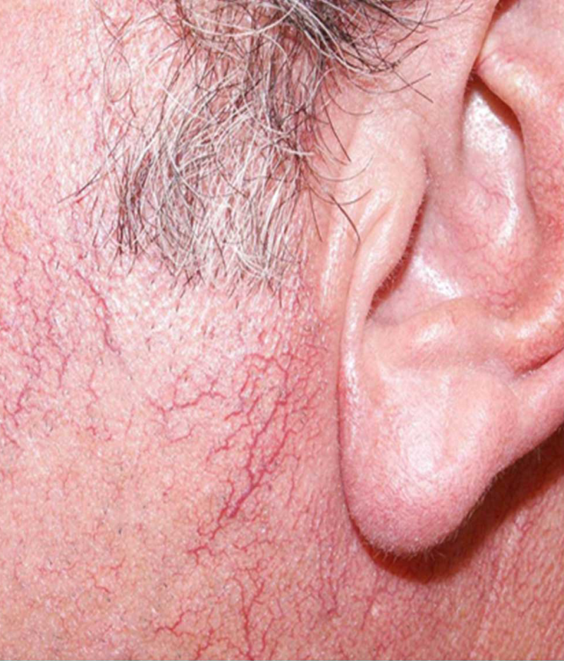 Pigment and Vascular Lesions The Laser Beautique