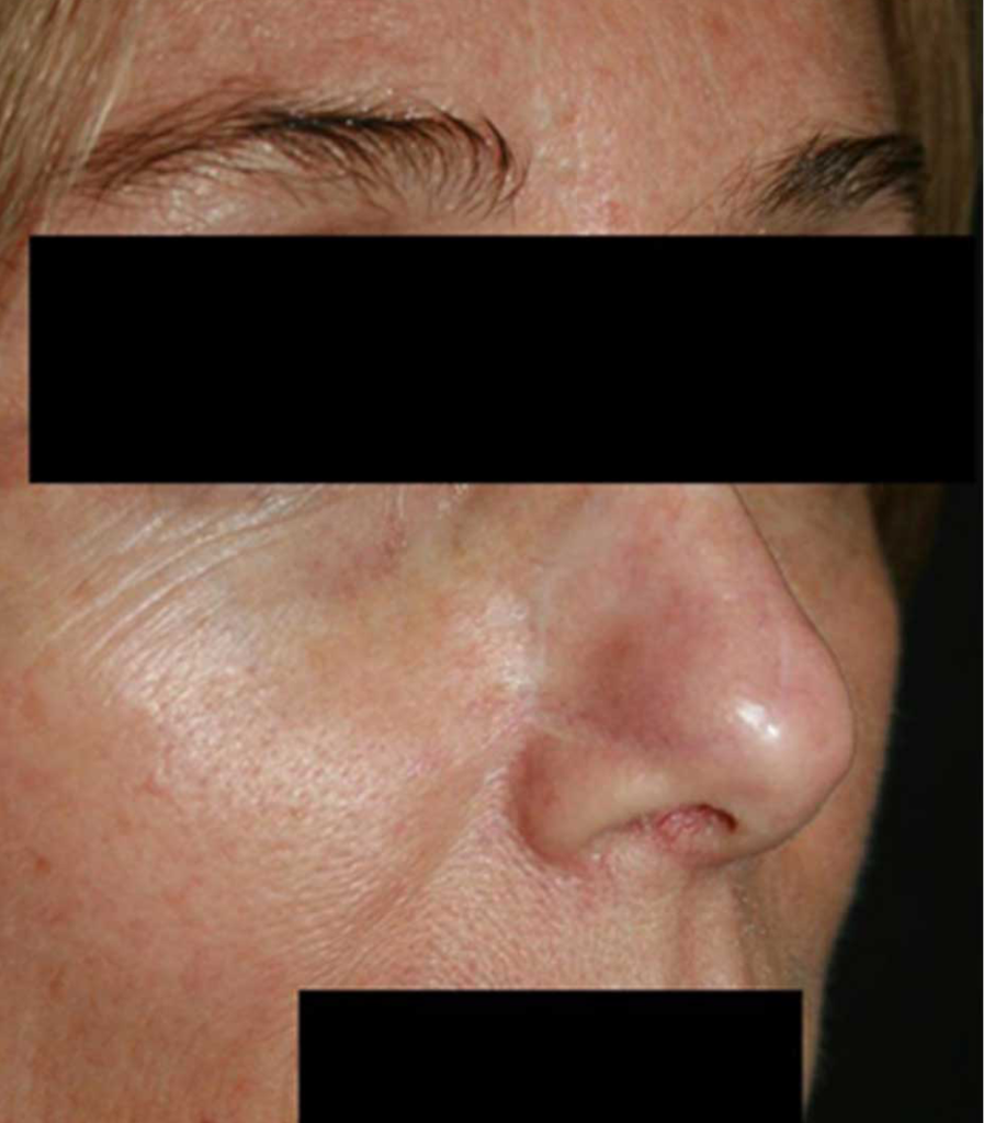 Pigment and Vascular Lesions | The Laser Beautique