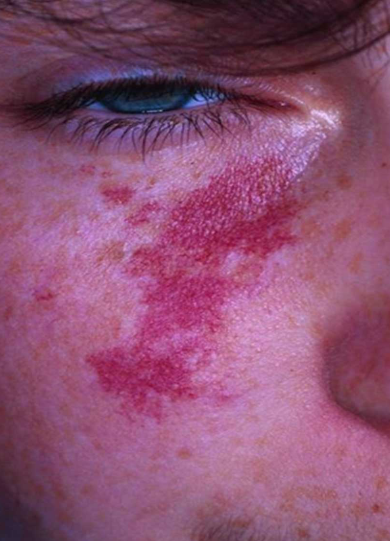 Pigment and Vascular Lesions The Laser Beautique