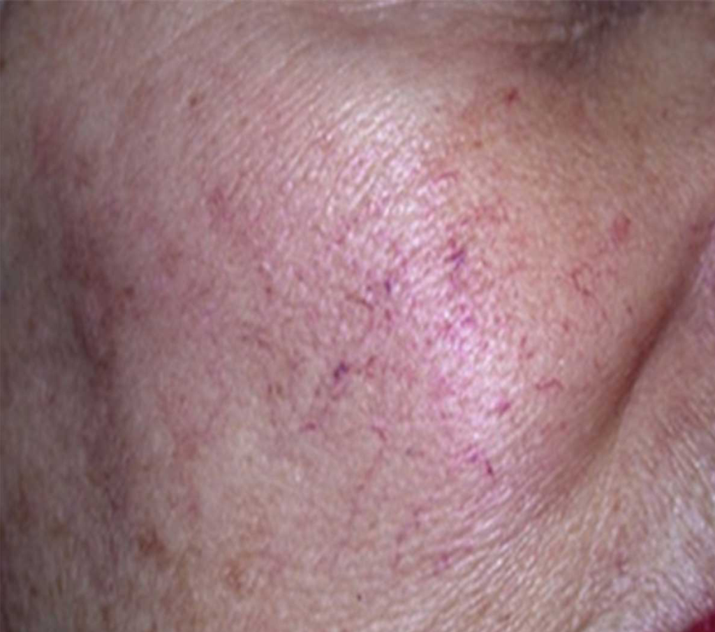 Pigment and Vascular Lesions The Laser Beautique