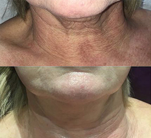 Skin Tightening Before and After