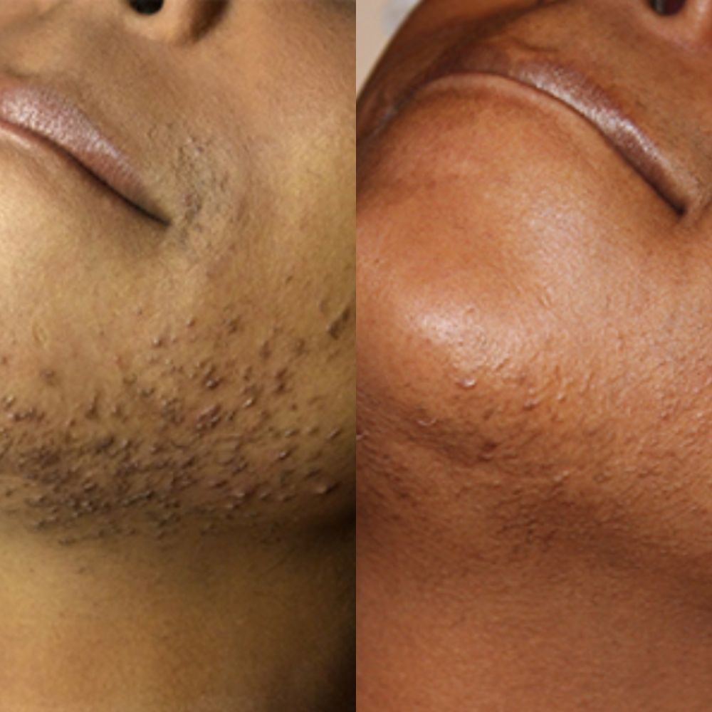 A woman's chin showing her results from before and after laser hair removal treatments at The Laser Beautique. On the left, she has inflamed ingrown hairs and thick, curly chin hairs. On the left, her chin has no hair and is completely smooth.