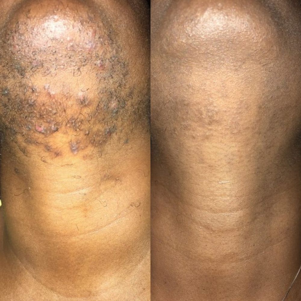 A man's chin showing his results from before and after laser hair removal treatments at The Laser Beautique. On the left, he has inflamed ingrown hairs and razor burns. On the left, his chin has no hair and is completely smooth.