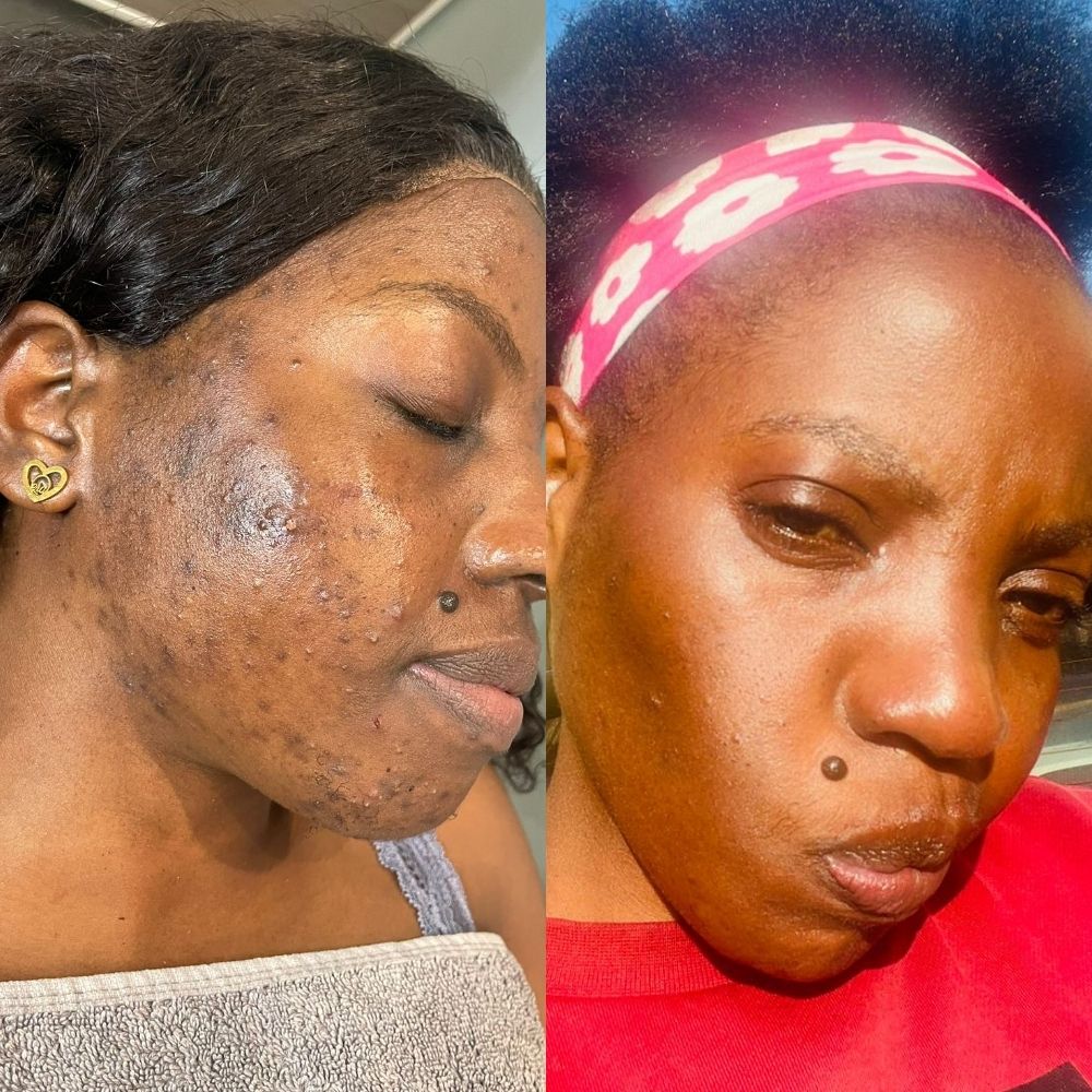 A woman's face showing her results from before and after receiving Scientific Skincare facial peels at The Laser Beautique. On the left, her skin has red and inflamed acne. On the right, her skin is clear and glowing.