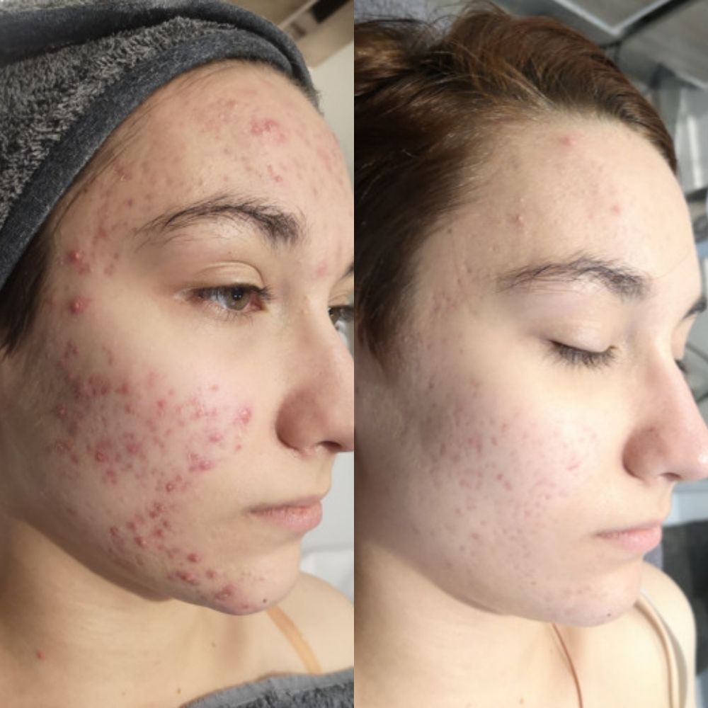 A woman's face showing her results from before and after receiving Scientific Skincare facial peels at The Laser Beautique. On the left, her skin has red and inflamed acne. On the right, her skin is clear and glowing.