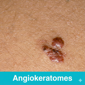 Angiokeratomas