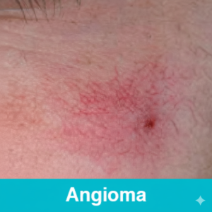 Angioma