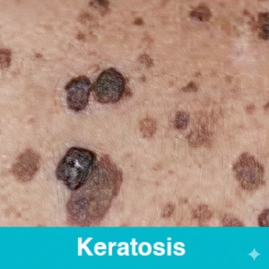 Keratosis
