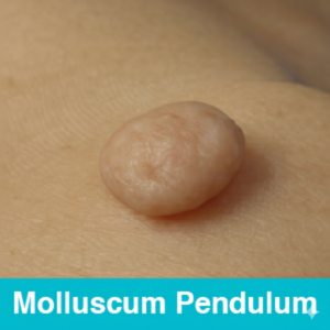Molluscum Pendulum