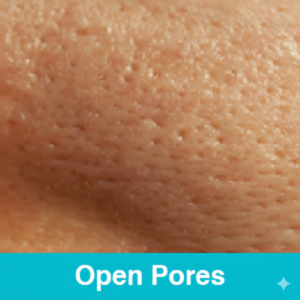 Open Pores