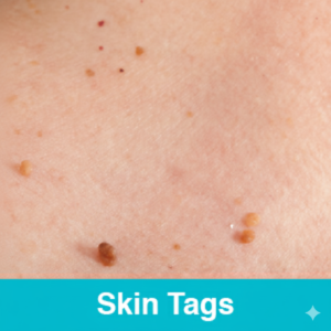 Skin Tags