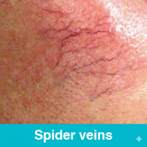 Spider Veins